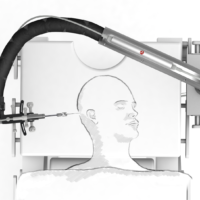 Nuova tecnica di chirurgia robotica otologica di precisione utilizzata dall’Otorinolaringoiatria dell’Aou Senese